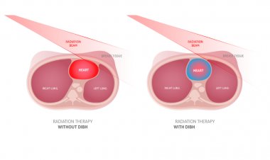 Deep Inspiratory Breath Hold (DIBH) is a game changing modern technique in Breast Cancer Radiotherapy